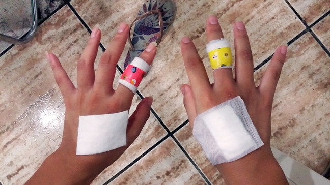 injured hands after kali sparring